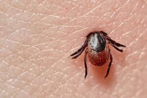 Deer tick embedded and feeding in human skin